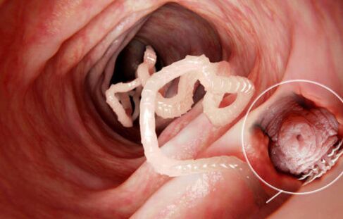 cacing itu adalah parasit dalam tubuh manusia
